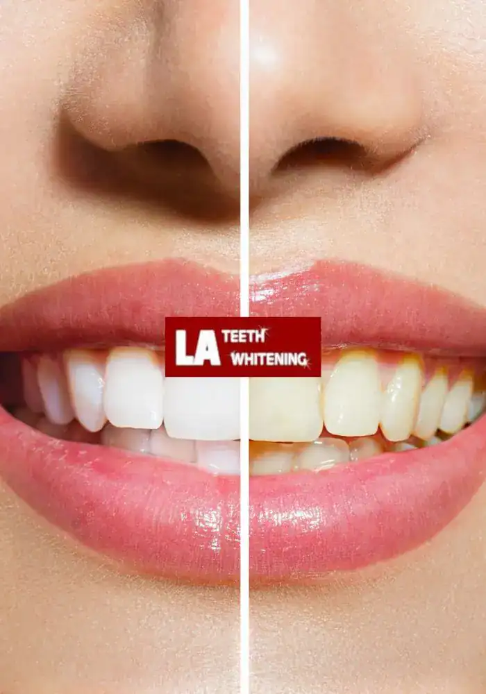 How Does 1 Hour Whitening Stack Up Against Traditional Dental Bleaching Melton Mowbray