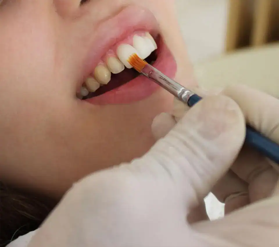 How Soon Can You Whiten After Different Dental Procedures Melton Mowbray