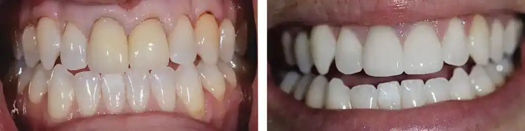How Long to Wait After Dental Work Before Whitening Your Teeth Melton Mowbray