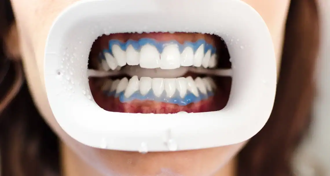 What If Your Dental Work Doesn’t Match Your Tooth Shade After Whitening Melton Mowbray